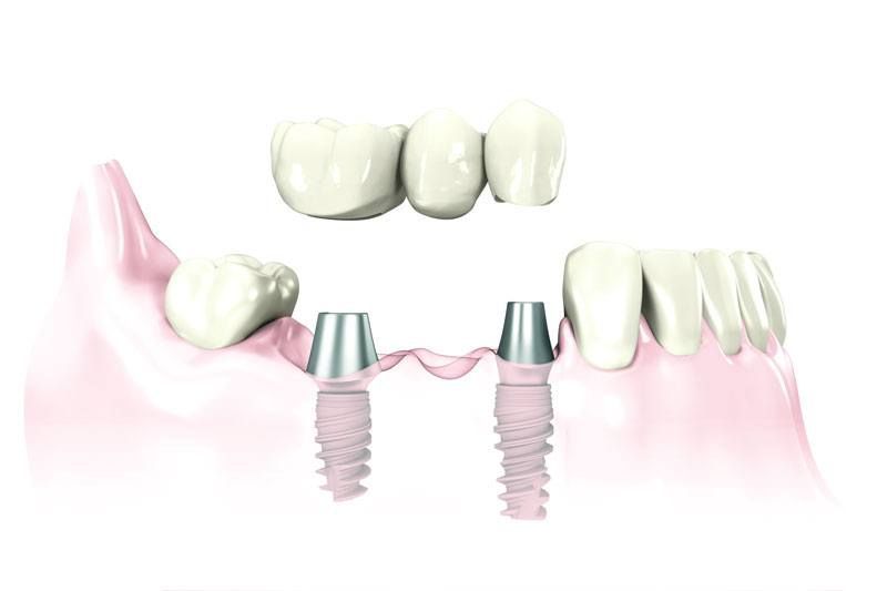 A computer generated image of a dental bridge with two dental implants.