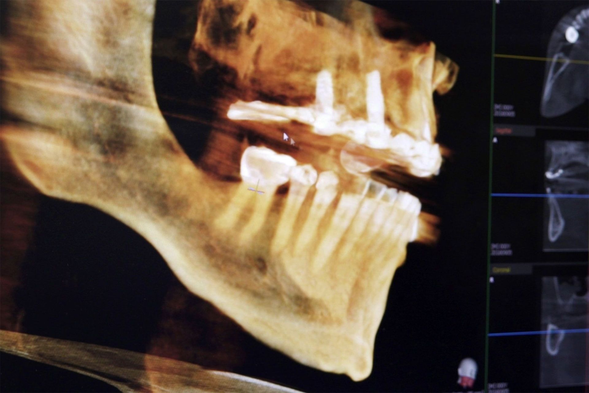 A close up of a skull and teeth on a computer screen.