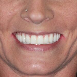 A close up of a woman 's smile with white teeth and a nose ring.