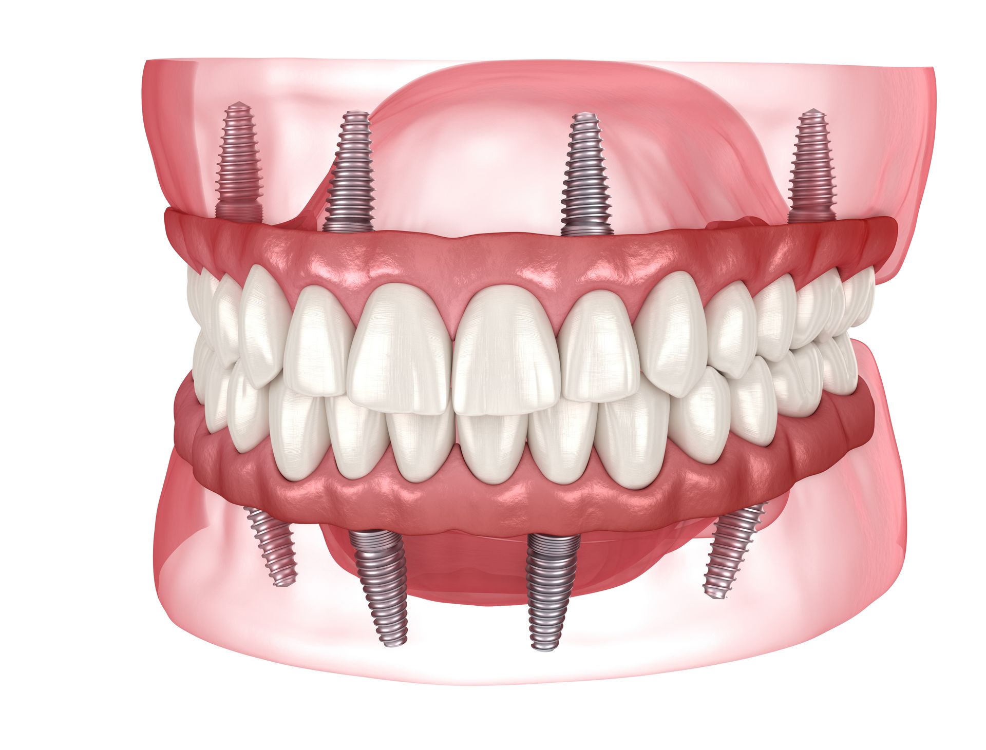 A model of a denture with dental implants in it.