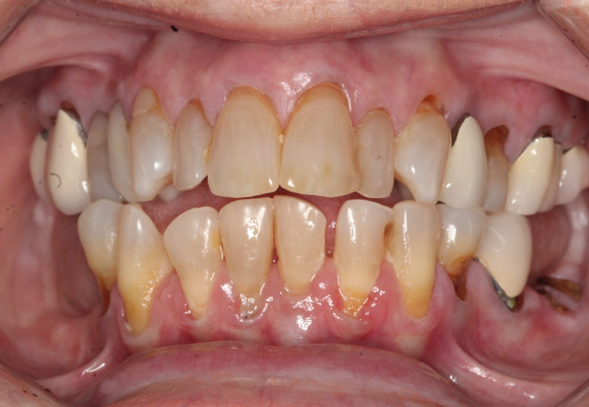 A close up of a person 's teeth with a lot of plaque on them.