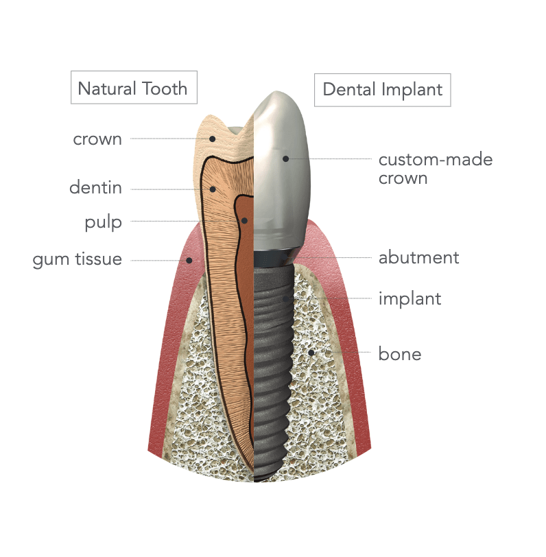 A diagram of a natural tooth and a dental implant.