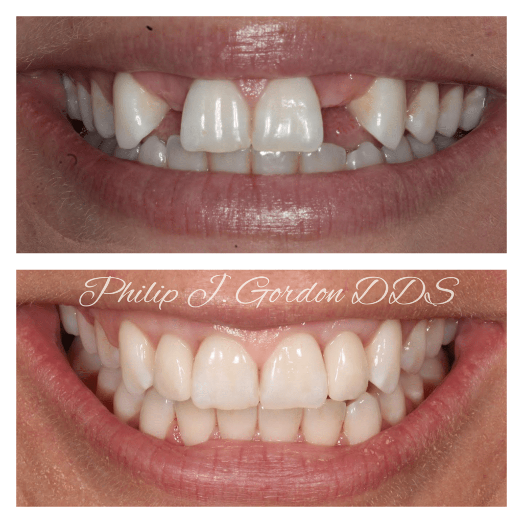 A before and after photo of a woman 's teeth by philip j gordon dds