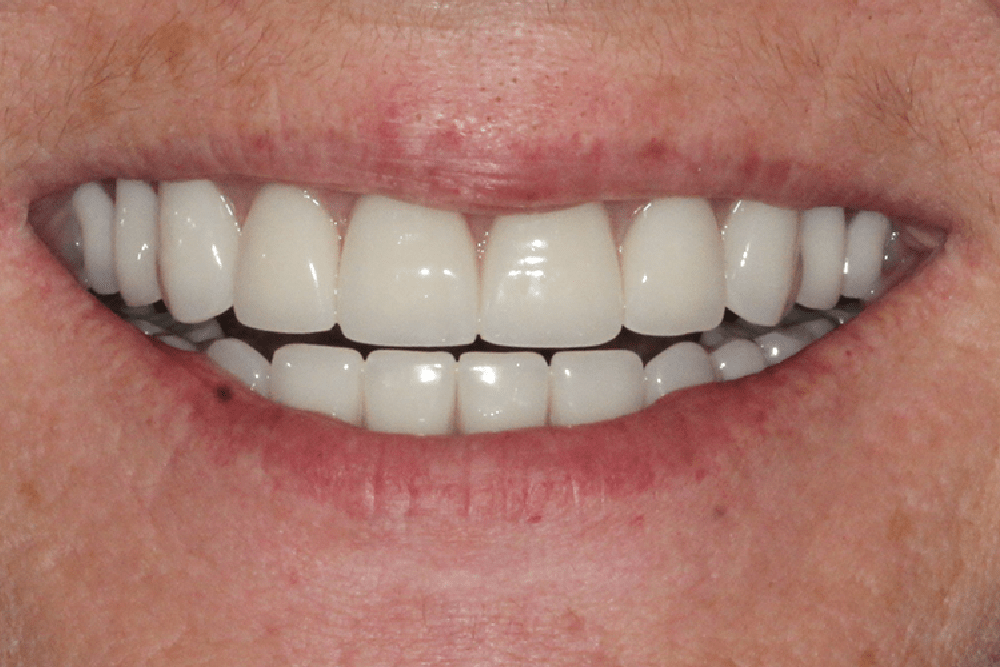 A close up of a woman 's smile with white teeth.