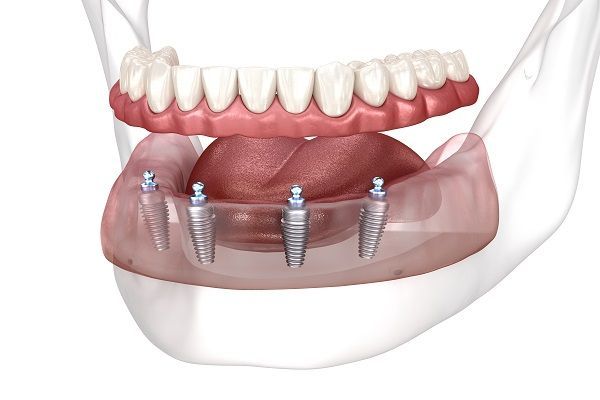 A computer generated image of a full denture with dental implants.