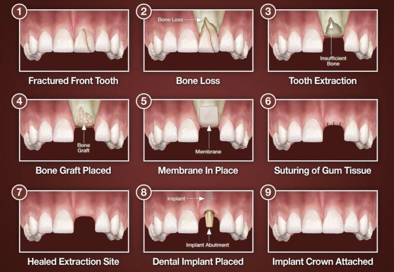 A diagram showing the different stages of dental implants