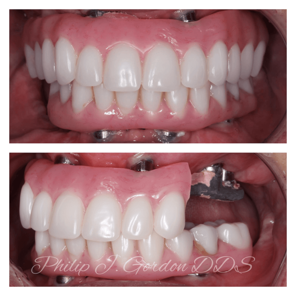 A before and after picture of a person 's teeth by philip j. gordon dds