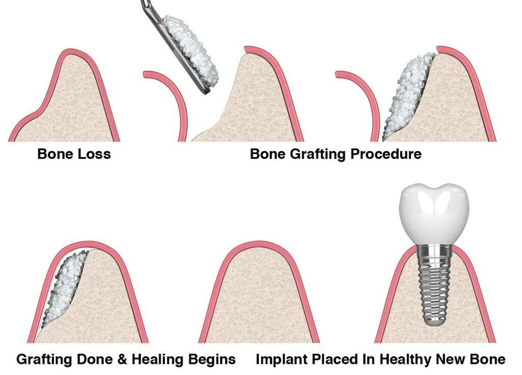 A diagram showing the process of a bone grafting procedure