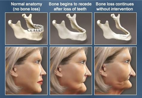 A woman 's face is shown in three different stages of bone loss.