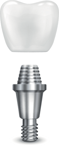 A dental implant with a crown on top of it.