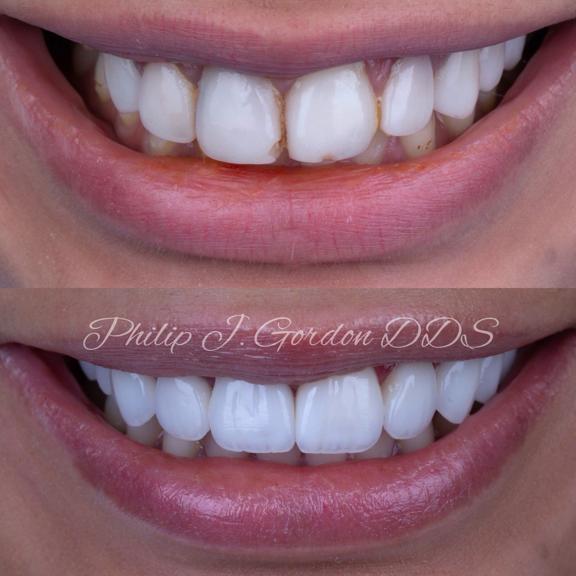 A before and after photo of a woman 's teeth.