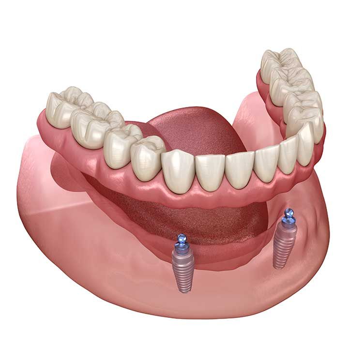 A computer generated image of a denture with two dental implants