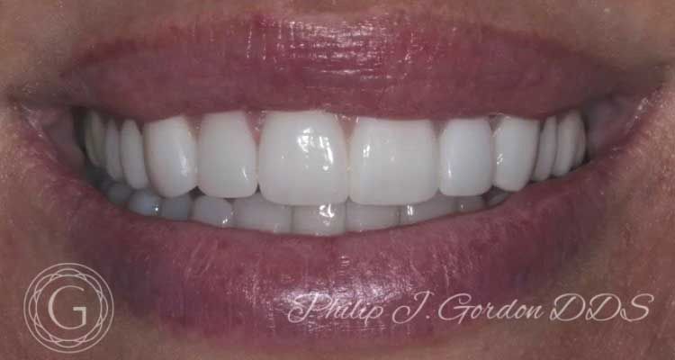 A close up of a woman 's mouth with white teeth by philip j gordon dds