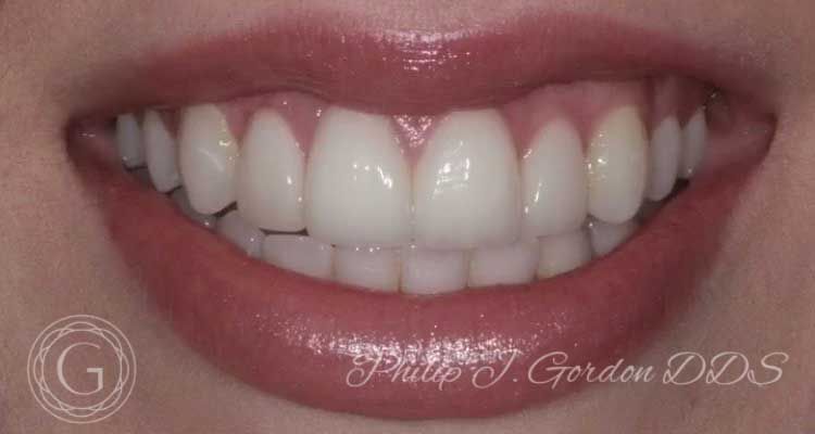 A close up of a woman 's teeth with phillip j gordon dds written on the bottom