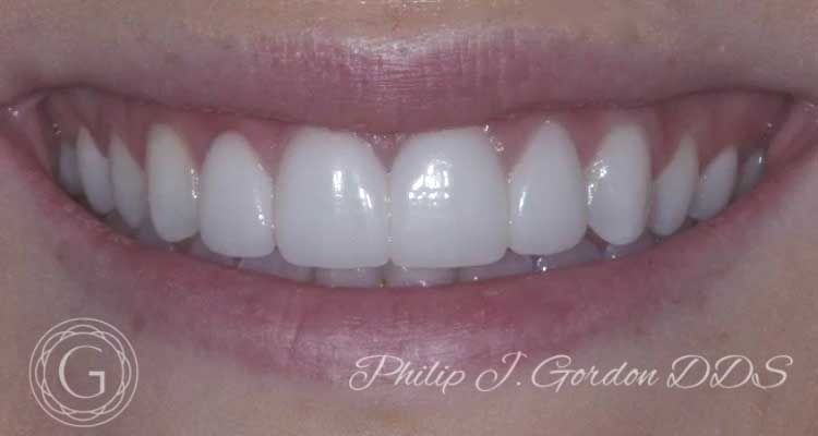 A close up of a woman 's teeth with philip j gordon dds written on the bottom