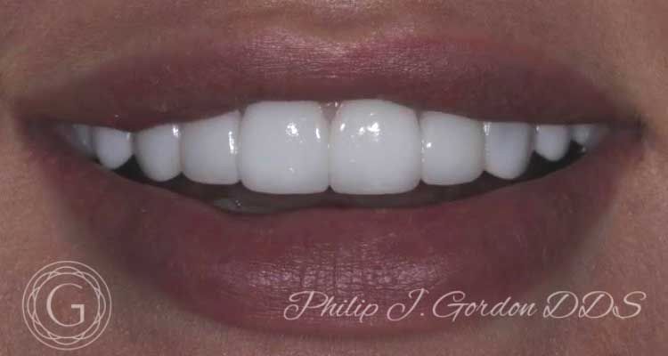 A close up of a woman 's teeth with philip j gordon dds written on the bottom