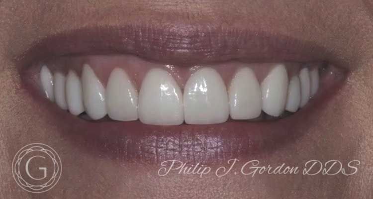 A close up of a woman 's mouth with white teeth.