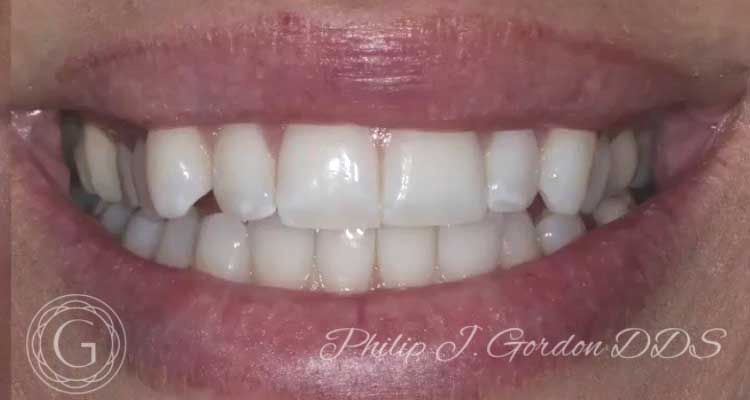 A close up of a woman 's teeth with philip j gordon dds written on the bottom