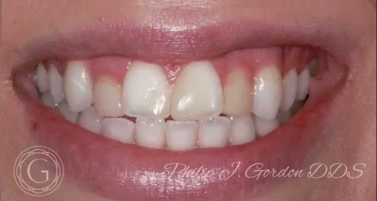 A close up of a woman 's mouth with white teeth.