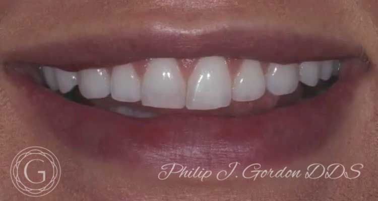 A close up of a woman 's teeth with the name philip j gordon dds