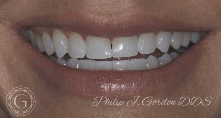 A close up of a woman 's teeth with the name philip j gordon dds on the bottom