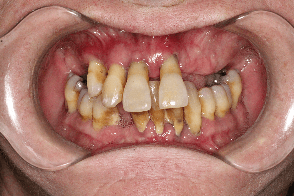 A close up of a person 's mouth with a lot of teeth.