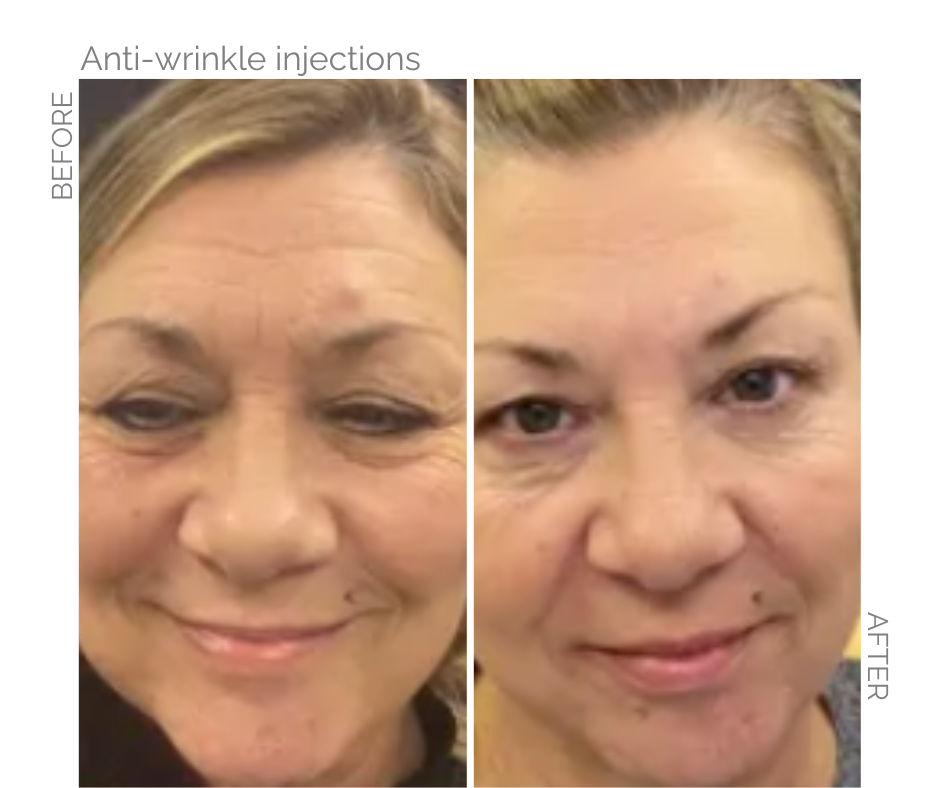 Anti wrinkle injections performed on this Norfolk lady's face