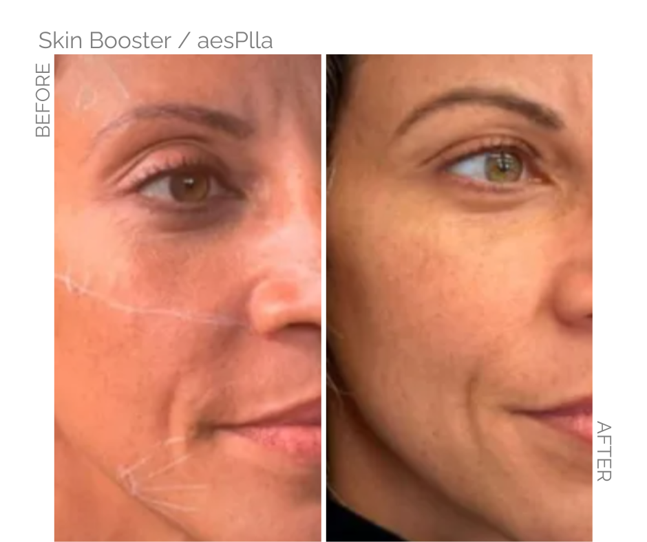 Skinbooster aesplla used in cheeks