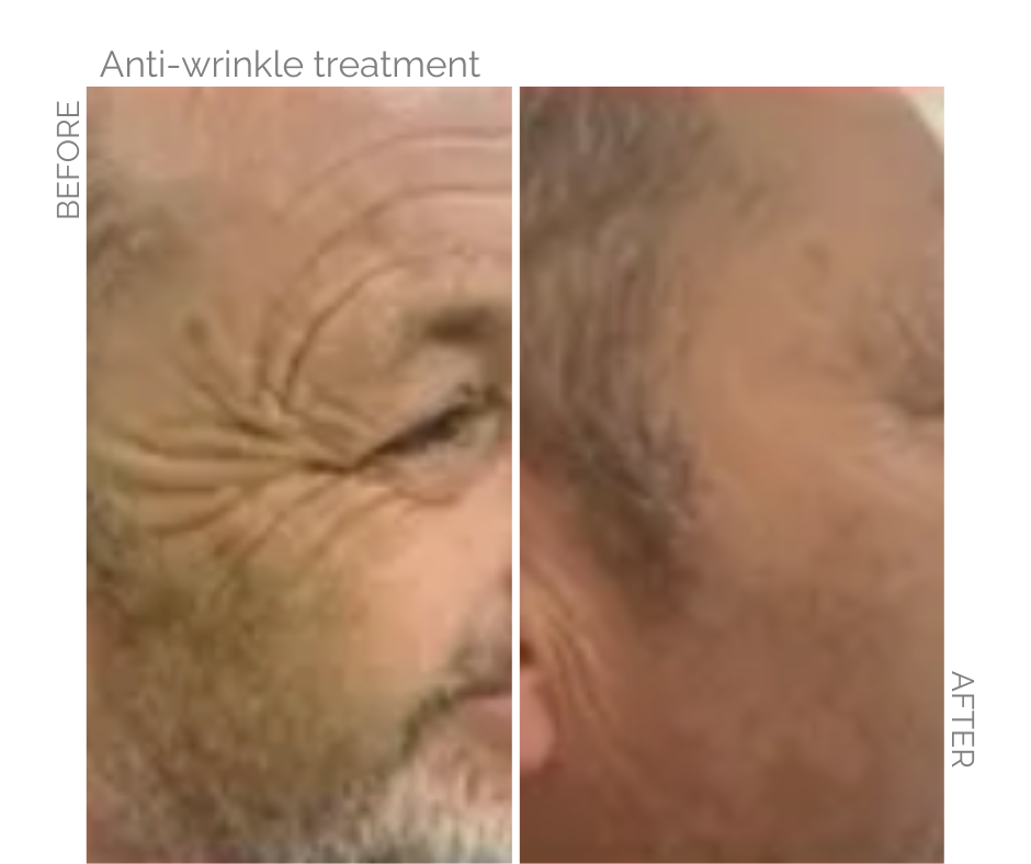 Anti wrinkle treatment performed on Norfolk man before and after