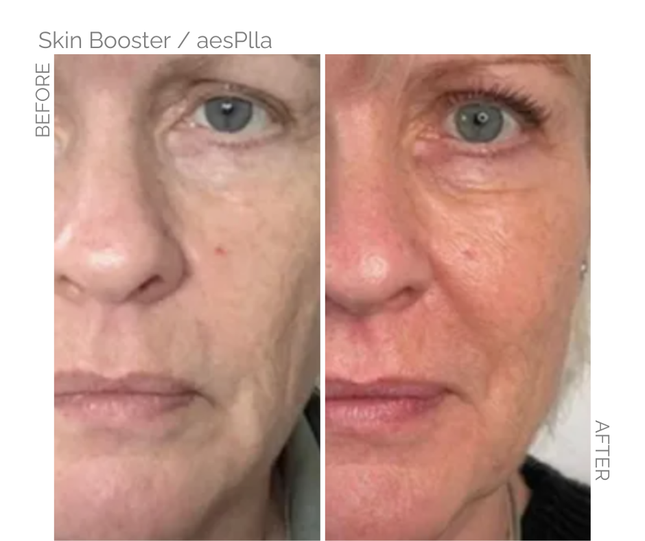 aesplla skinbooster on face Before and after