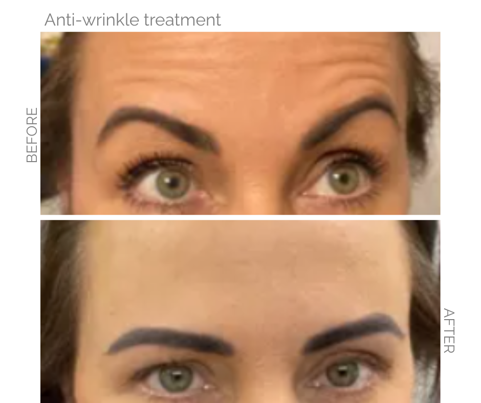 anti wrinkle treatment on Norfolk lady before and after