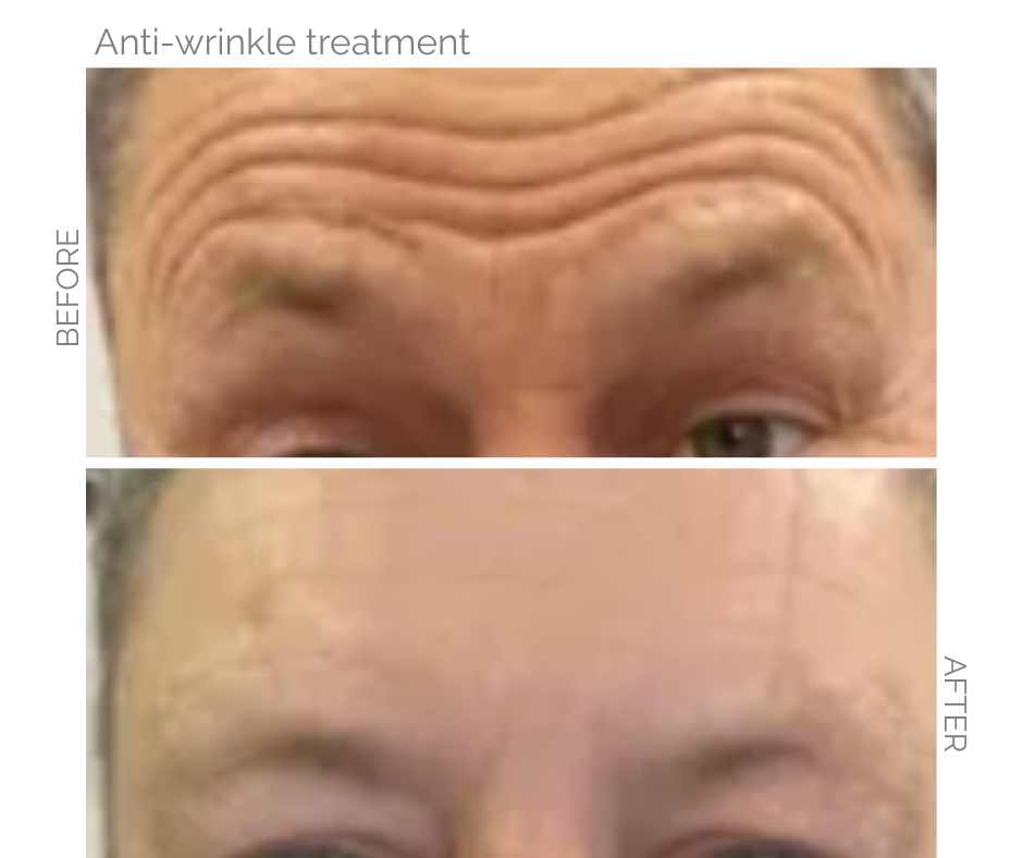 Before and after pics of Norwich man who had anti wrinkle injections on forehead