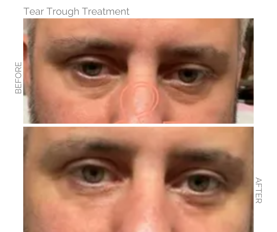 Tear trough treatment an effective eye treatment for a man in Norwich before and after