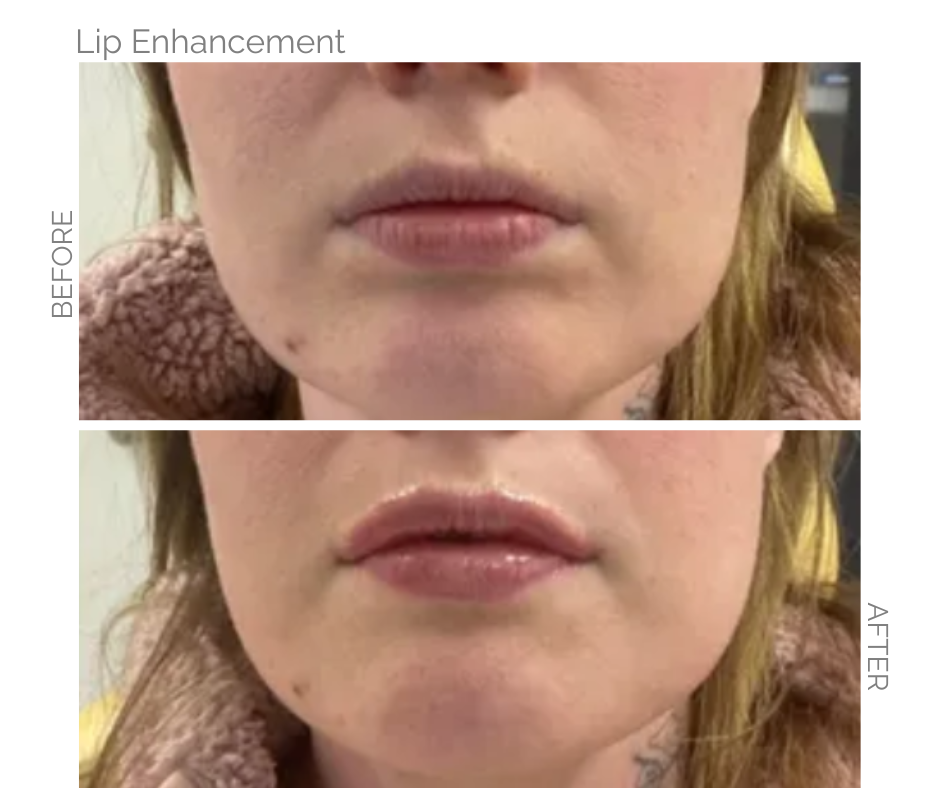 Lips enhanced in Norwich on lady