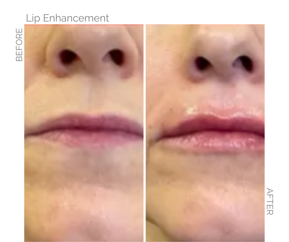 Fuller lips with lip filler on Norwich lady before and after