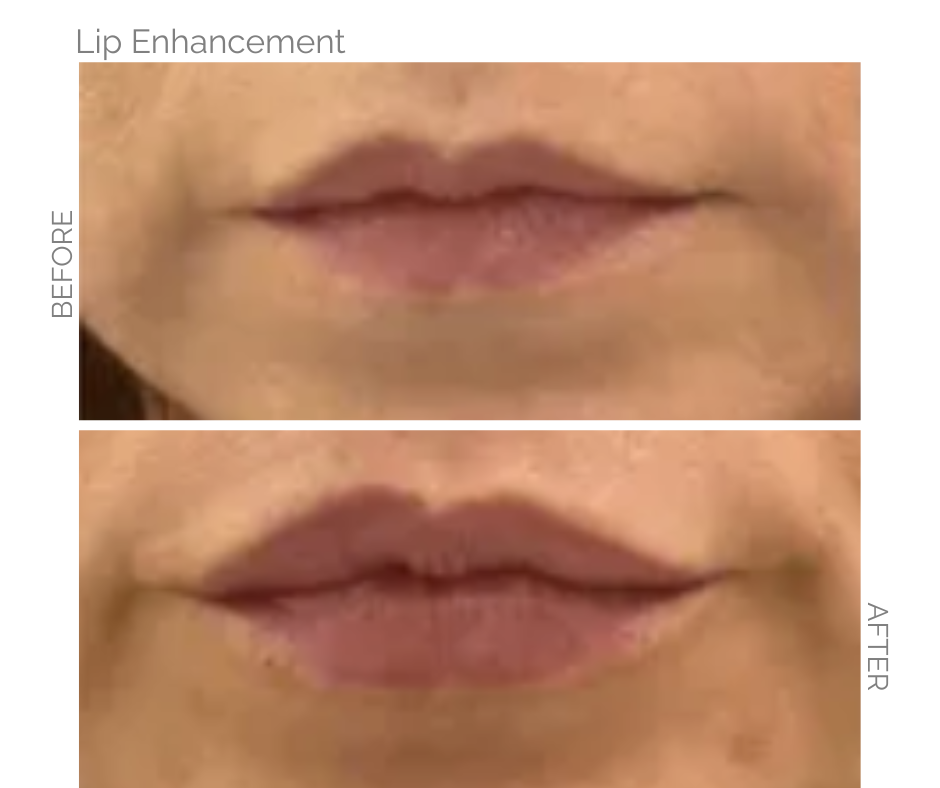 Lip enhancement comparison: Before and after lip filler treatment, showing fuller lips.