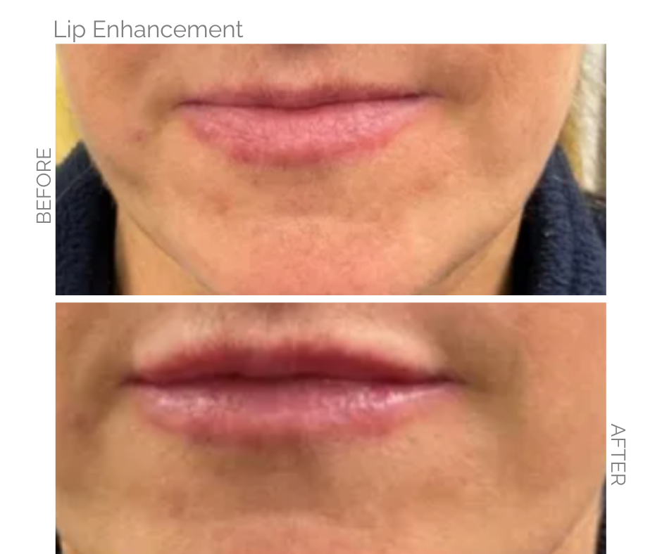 A top lip enhancement performed in Norwich without surgery 