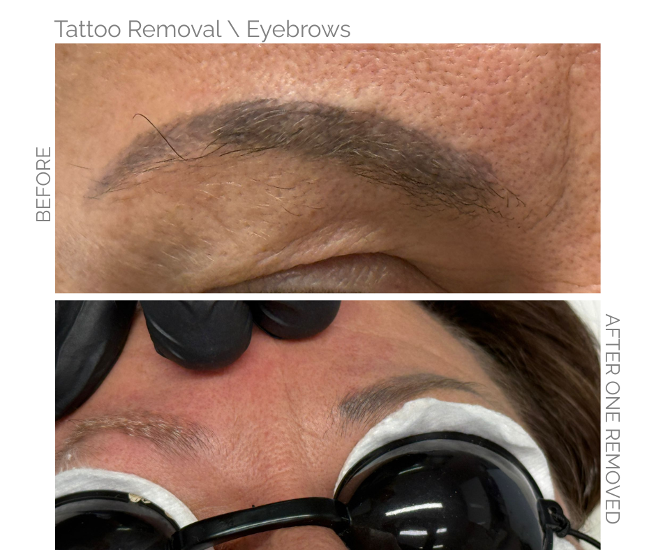 Before and after eyebrow tattoo removal. Top: dark tattooed eyebrow. Bottom: lighter eyebrow with tattoo removed.  