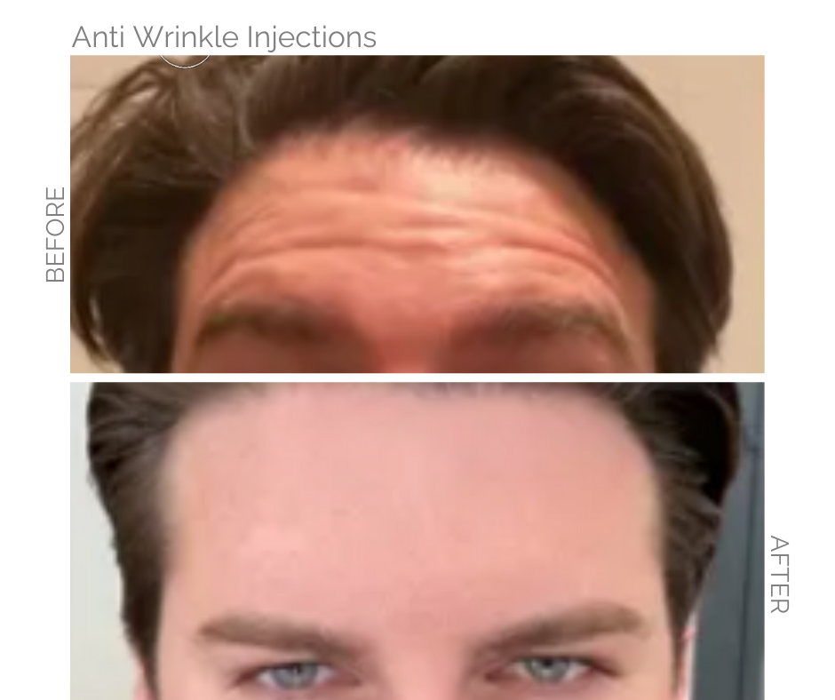 Comparison of a man's forehead before and after anti-wrinkle injections, showing a reduction in wrinkles.