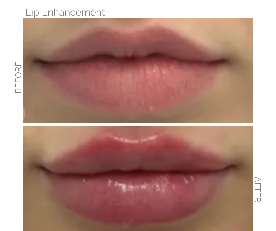 Lip enhancement comparison: Before and after photos of lips; showing increased volume and plumpness.