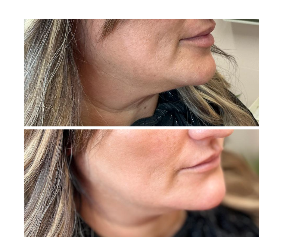 Chin enhancement with filler