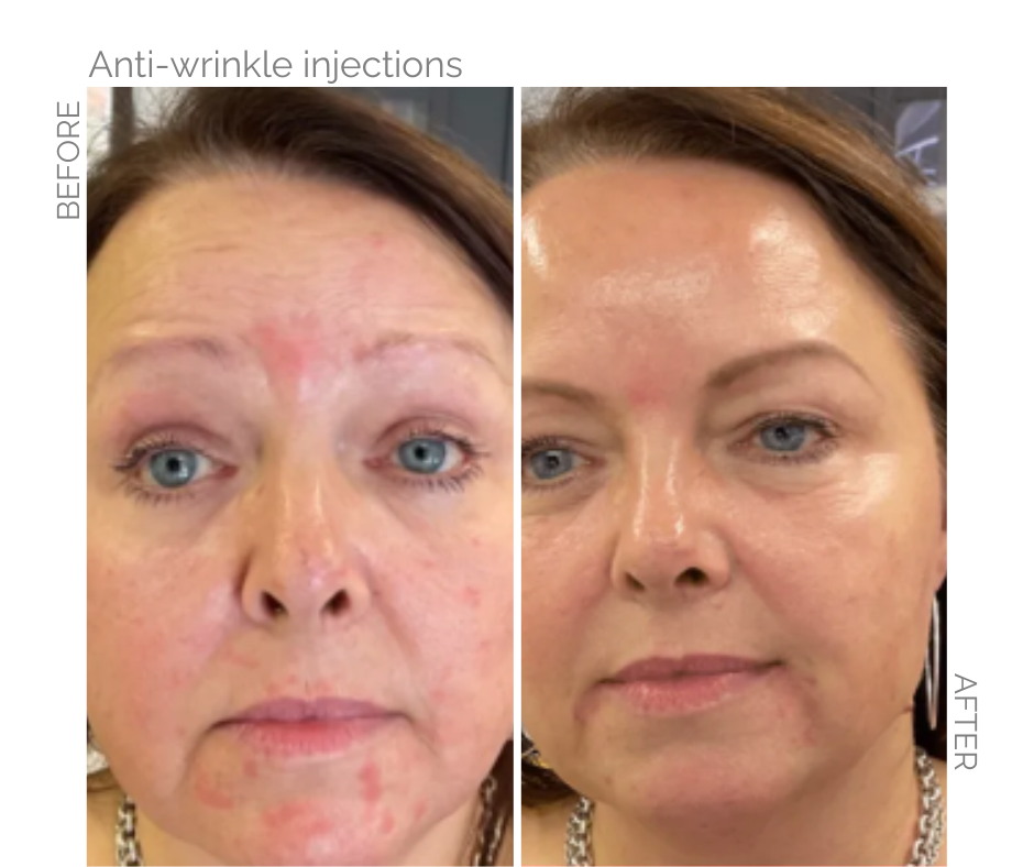 Norwich woman who had anti wrinkle injections on the face