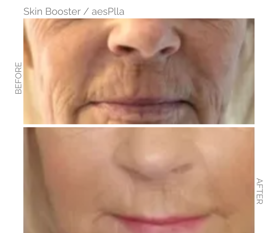 Before and after skin booster aesplla on mouth lines and face