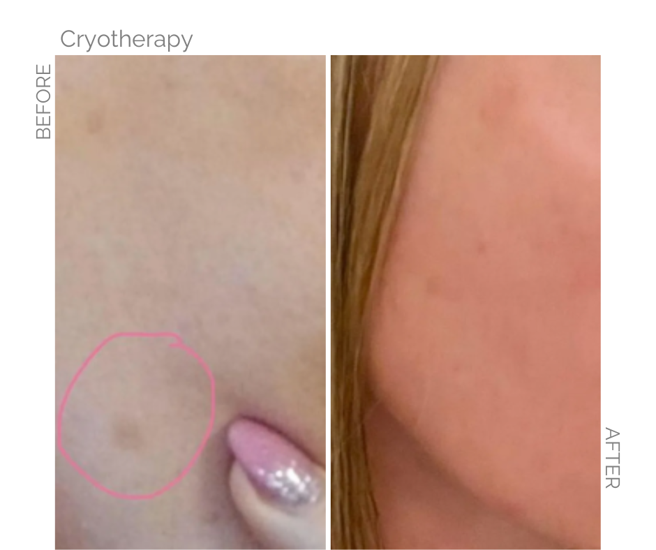Cryotherapy treatment on this Norwich lady, before and after pictures