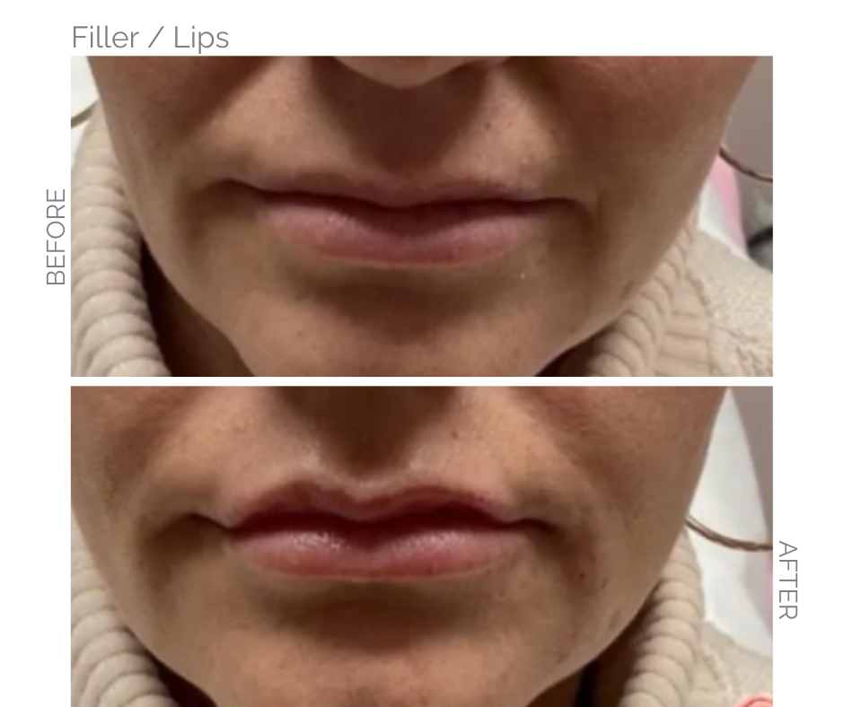 Lips Before and Lips after with filler