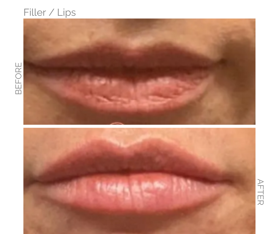 A perfect pout afterwards with lip filler