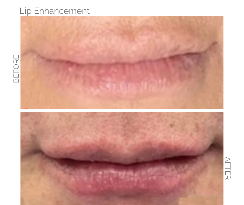 Lip enhancement comparison: Before shows thin lips, after shows fuller, pink lips. Transforms lips with lip filler.