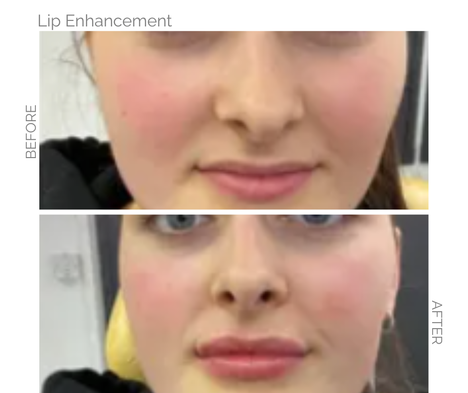 Lip enhancement comparison: Before and after of a person's lips. The 