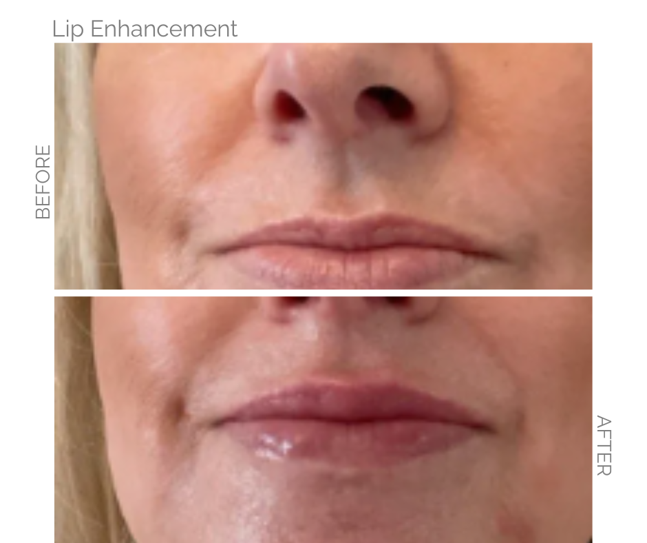 Before-and-after of lip enhancement. Top: thin lips. Bottom: fuller, enhanced lips and defined lips.