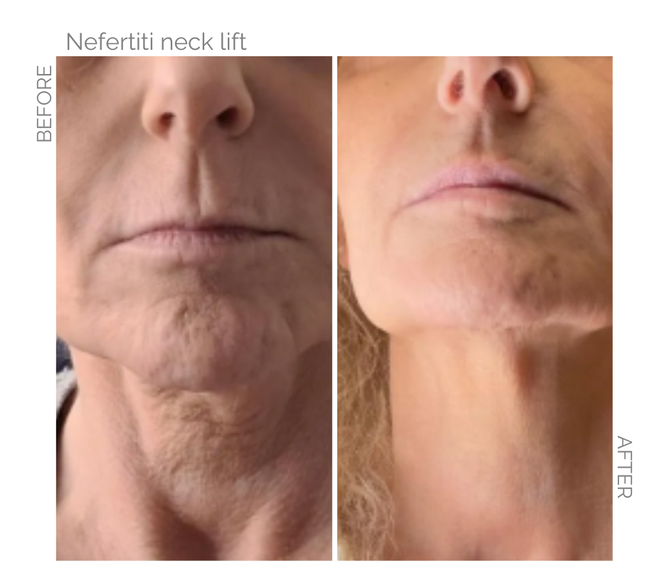 Side-by-side comparison: neck before and after a Nefertiti lift, showing reduced sagging and enhanced jawline definition.